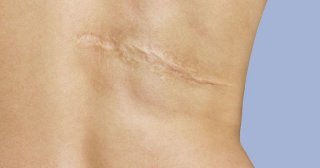 Entretenir sa cicatrice post-chirurgie