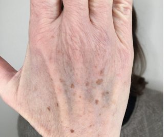 Eliminer les taches pigmentaire au laser : la solution pour un teint uniforme